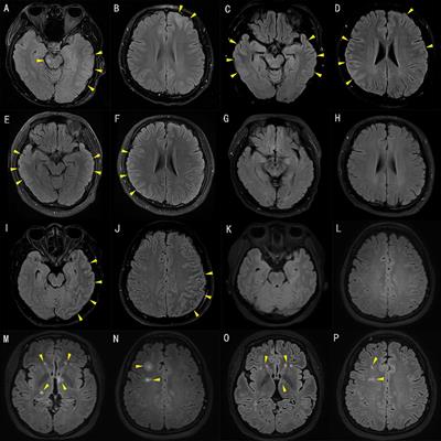 Two case reports and a systematic review of the literature on adult cerebral cortical encephalitis with anti-myelin oligodendrocyte glycoprotein antibody